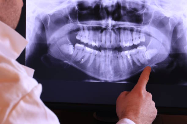 Best Emergency Wisdom Teeth Removal in Greens Farms, CT